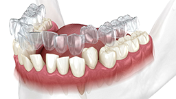 Ortodoncia invisible