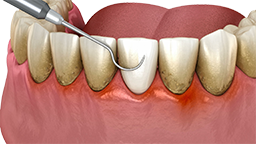 Periodoncia